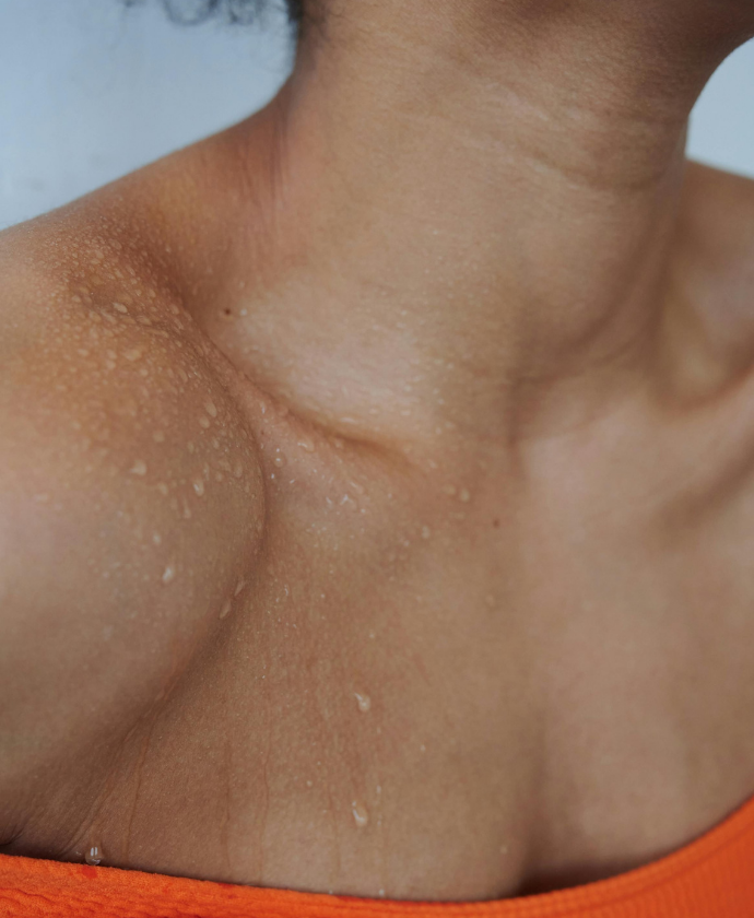 Hiperhidrosis